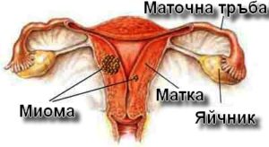 Туморът миома се развива в мускулната тъкан на матката.