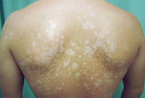 лечение на разноцветен лишей снимки