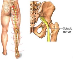 Ishias sedalishten nerv 2