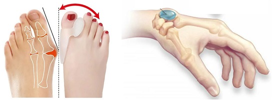valgus-01