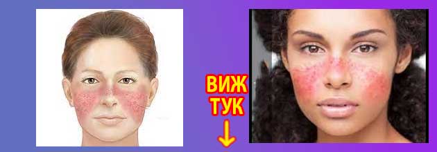 Колко години се живее с лупус 2