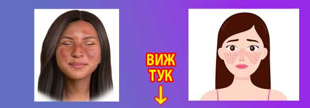 Колко години се живее с лупус 3