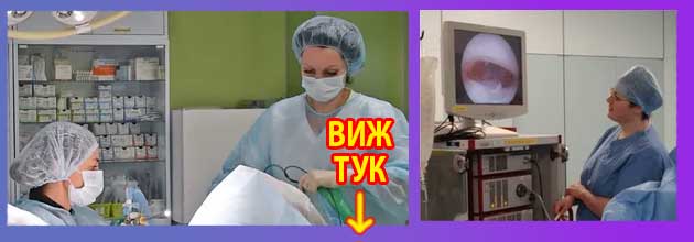 Може ли полип на матката да изчезне сам 3