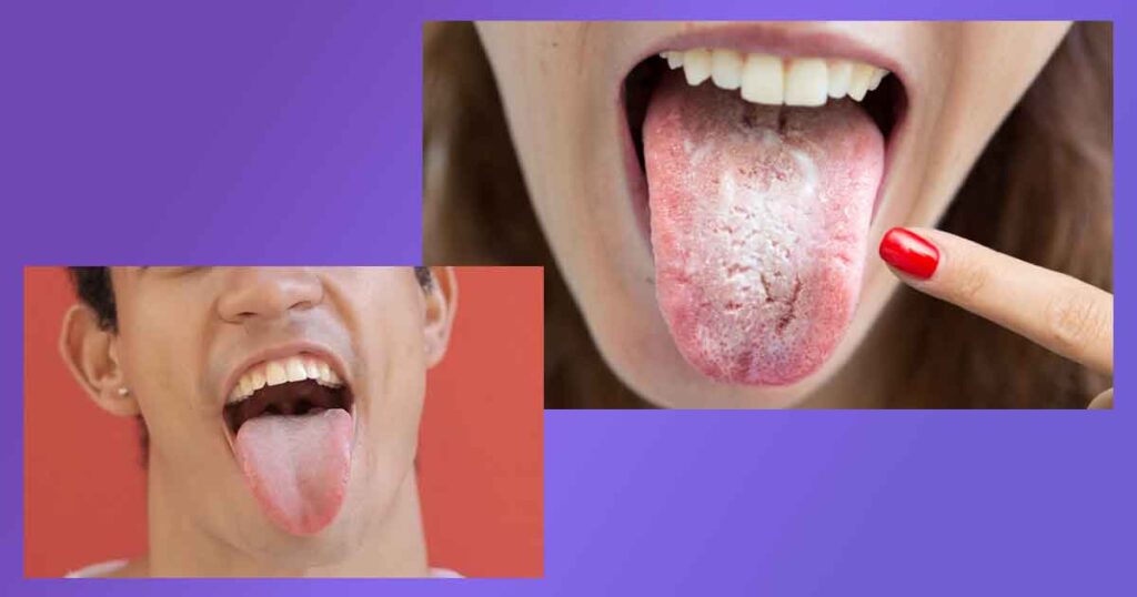 Възможни причини за бял език и сухота в устата. Географски език. Най-добро лекарство за обложен език. Справяне с налепи по езика и побелял език при възрастни и деца.