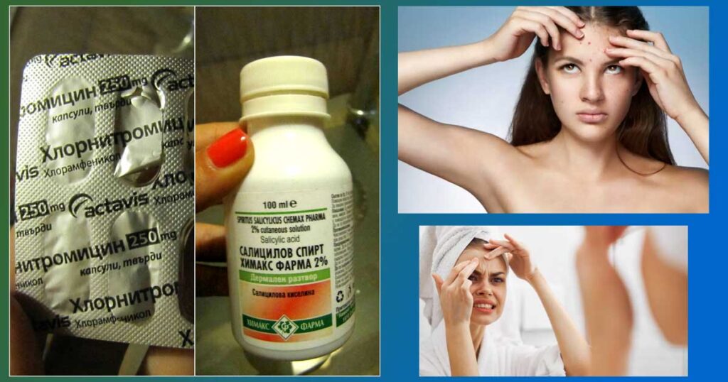 Как се ползва салицилов спирт и антибиотик за акне: Хлорнитромицин за пъпки или Гентамицин ампули? Сулфатиазол на прах (Сулфатиацол). Маска с аспирин. Кой е добрият крем с антибиотик за акне?