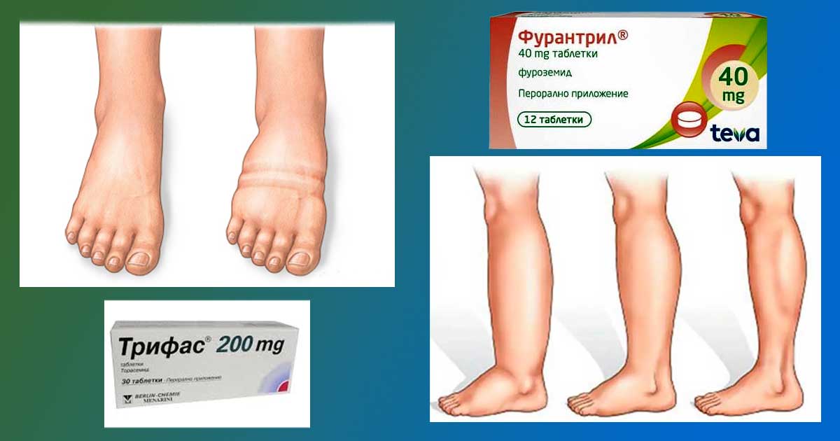 Точно какво се пие при задържане на вода: Бабини рецепти при задържане на течности. Кое е най-ехикасното лекарство за отводняване при асцит. Фурантрил, Трифас.