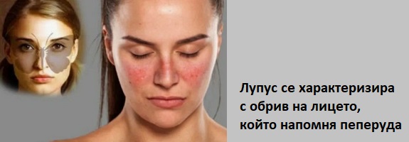 Лупус еритематозус 02